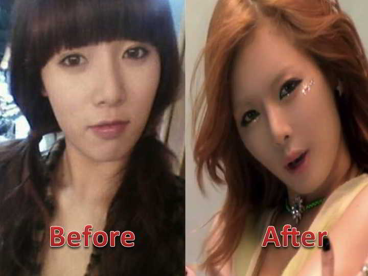 Hyuna-rhinoplasty-nose-surgery