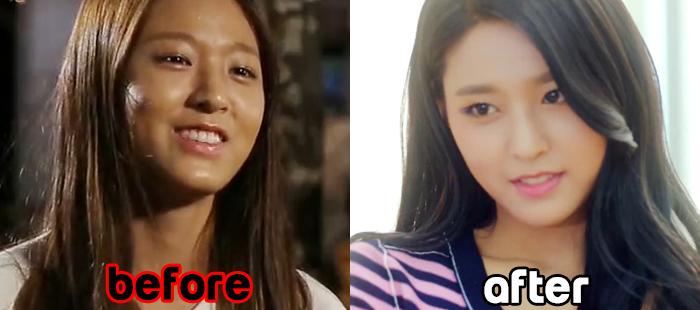 seolhyun before and after 6564
